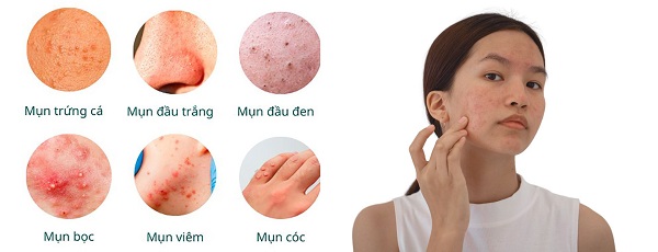 Phân loại thâm mụn thường gặp